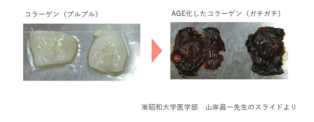 左側には通常のプルプルした白色のコラーゲン、右側にはAGEs化し黒焦げた色をしたコラーゲンの写真（※昭和大学医学部　山岸昌一先生のスライドより）