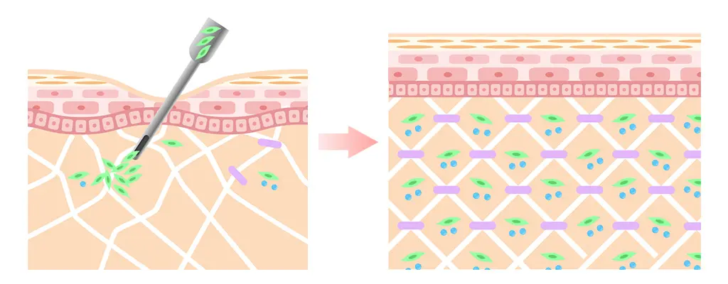 【肌の再生医療動画】より線維芽細胞移植治療効果を表現したイラスト