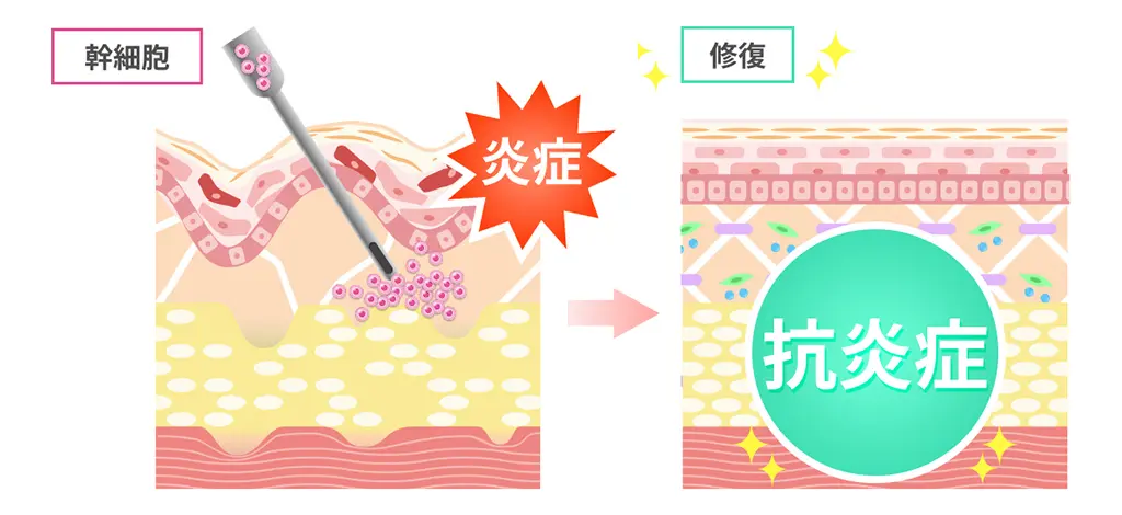 【糖化動画】より抗炎症のイメージイラスト
