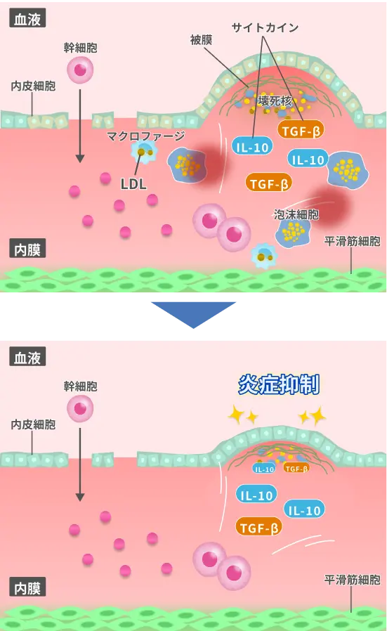 血管内でマクロファージや泡沫細胞がLDLを取り込み炎症を起こしている様子と、IL-10やTGF-βにより血管内の炎症が抑制され内皮細胞が回復する過程を示した図