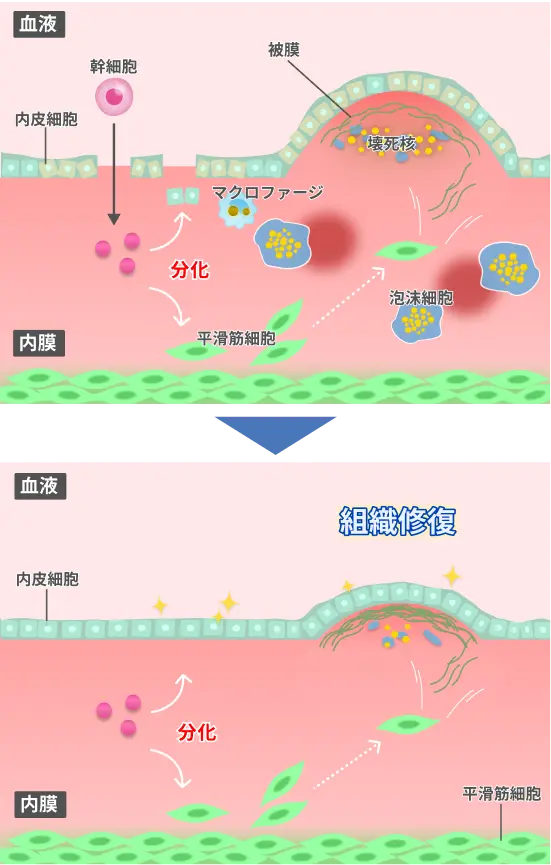 血管の損傷部位に幹細胞が集まり平滑筋細胞へ分化して組織修復が進むプロセスを示したイラスト。マクロファージや泡沫細胞の減少と血管壁の再生を表現