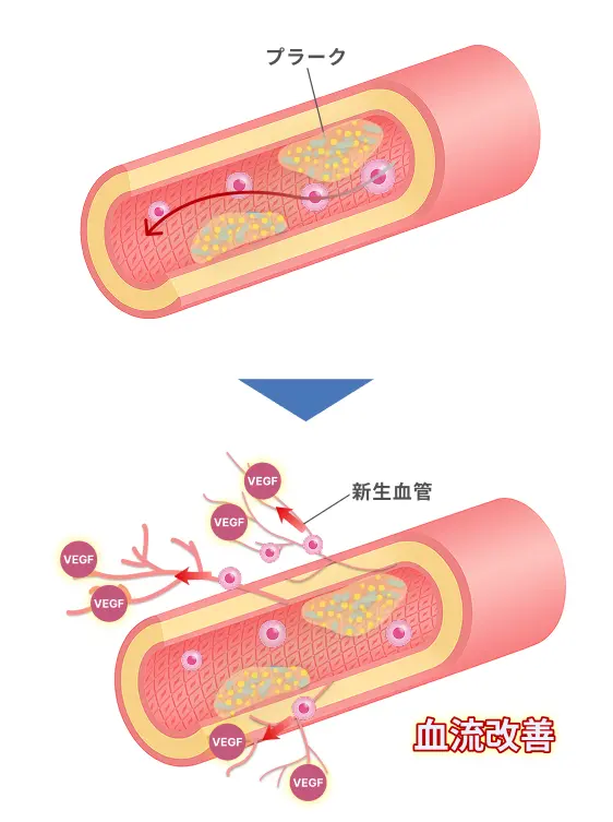 血管内のプラークが存在する状態から、VEGFによる新生血管形成により血流が改善していく仕組みを説明したイラスト