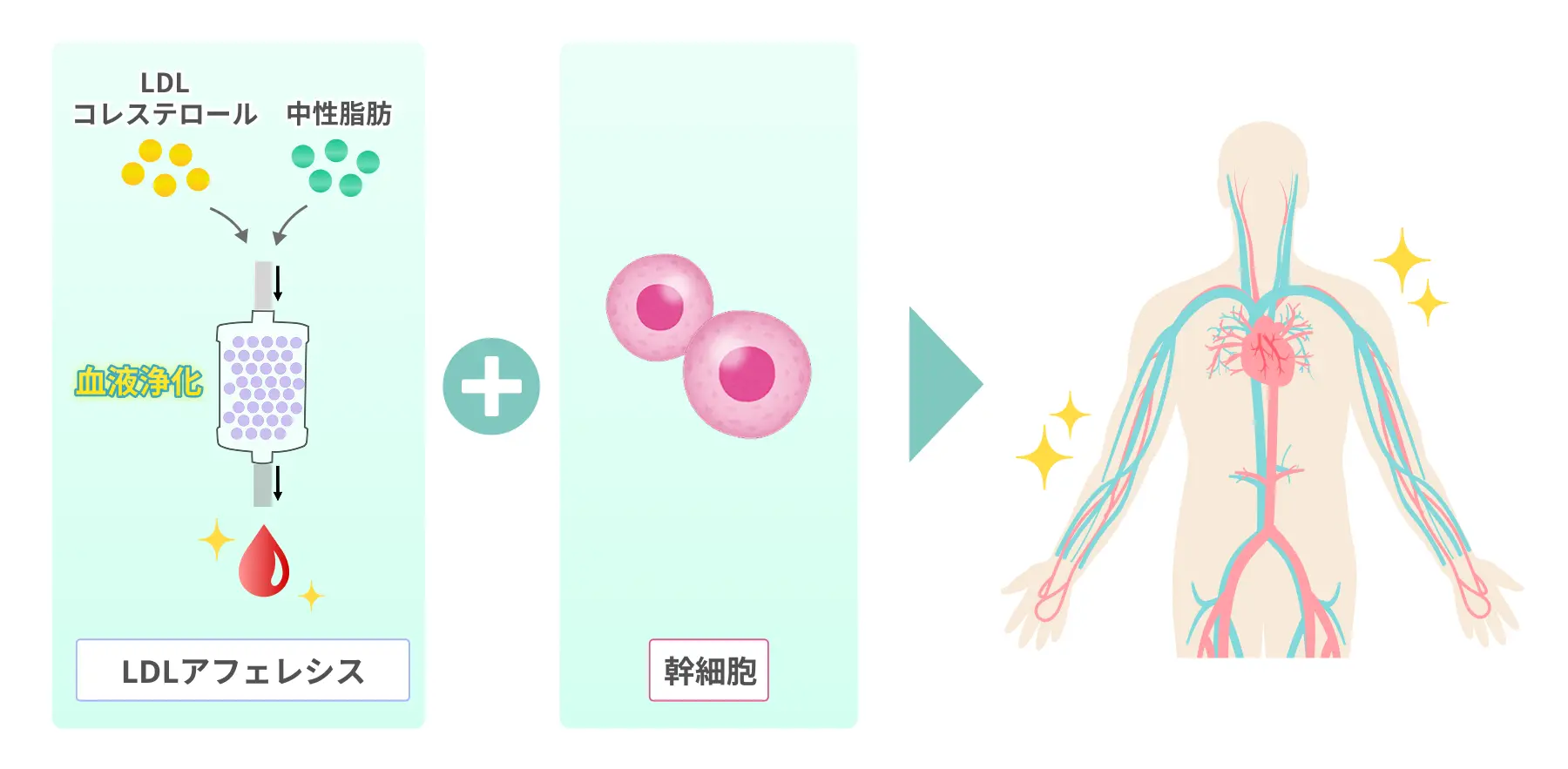 LDLアフェレシスでコレステロールや中性脂肪を除去し、幹細胞治療を併用することで全身の血流改善と血管機能向上を目指す治療イメージ図