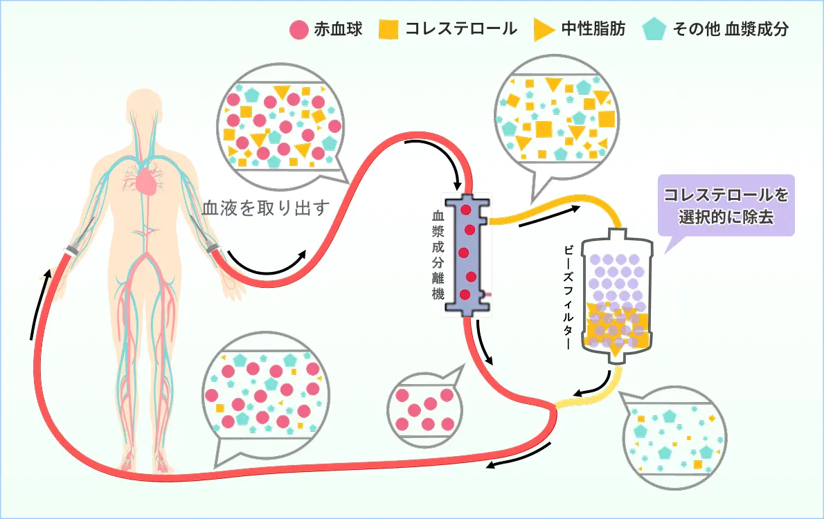 血液を取り出して血漿成分と分離し、ビーズフィルターでLDLコレステロールを選択的に除去して体内へ戻すLDLアフェレシスの仕組みを説明した図解