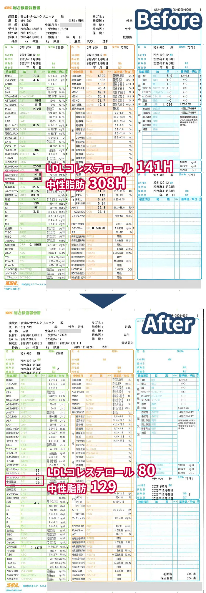 LDLコレステロール141・中性脂肪308だった血液検査結果が、治療後にLDLコレステロール80・中性脂肪129へ改善したビフォーアフターの血液検査比較画像