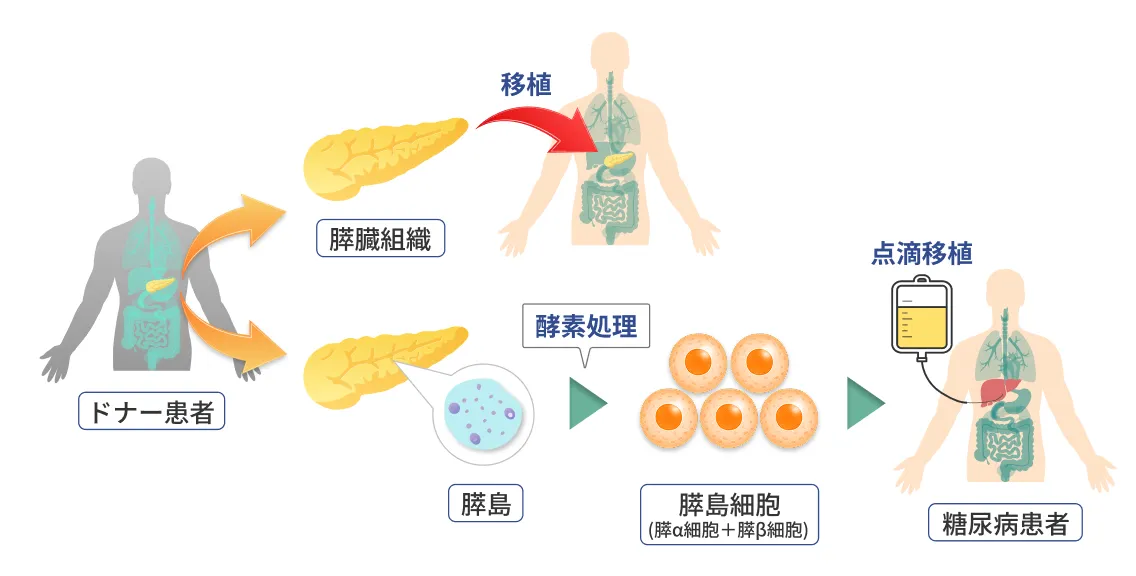 ドナー(死亡者)からの膵または膵島移植