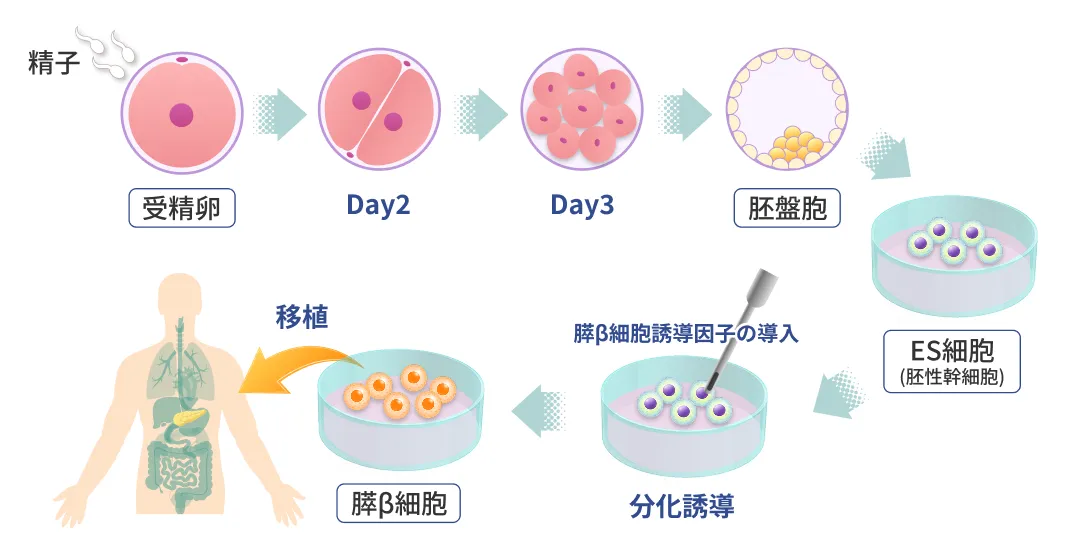 ドナー由来の胚性細胞(ES細胞)から作製するβ細胞の移植