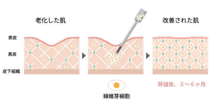 減少した線維芽細胞の補充による肌の再生を表現したイラスト（「老化した肌」に線維芽細胞を打つと「改善された肌」になる）