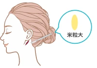 患者様の耳の後ろから皮膚片を少し採取しているイラスト
