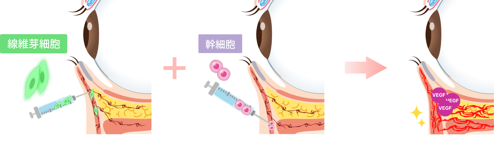 深いほうれい線の図