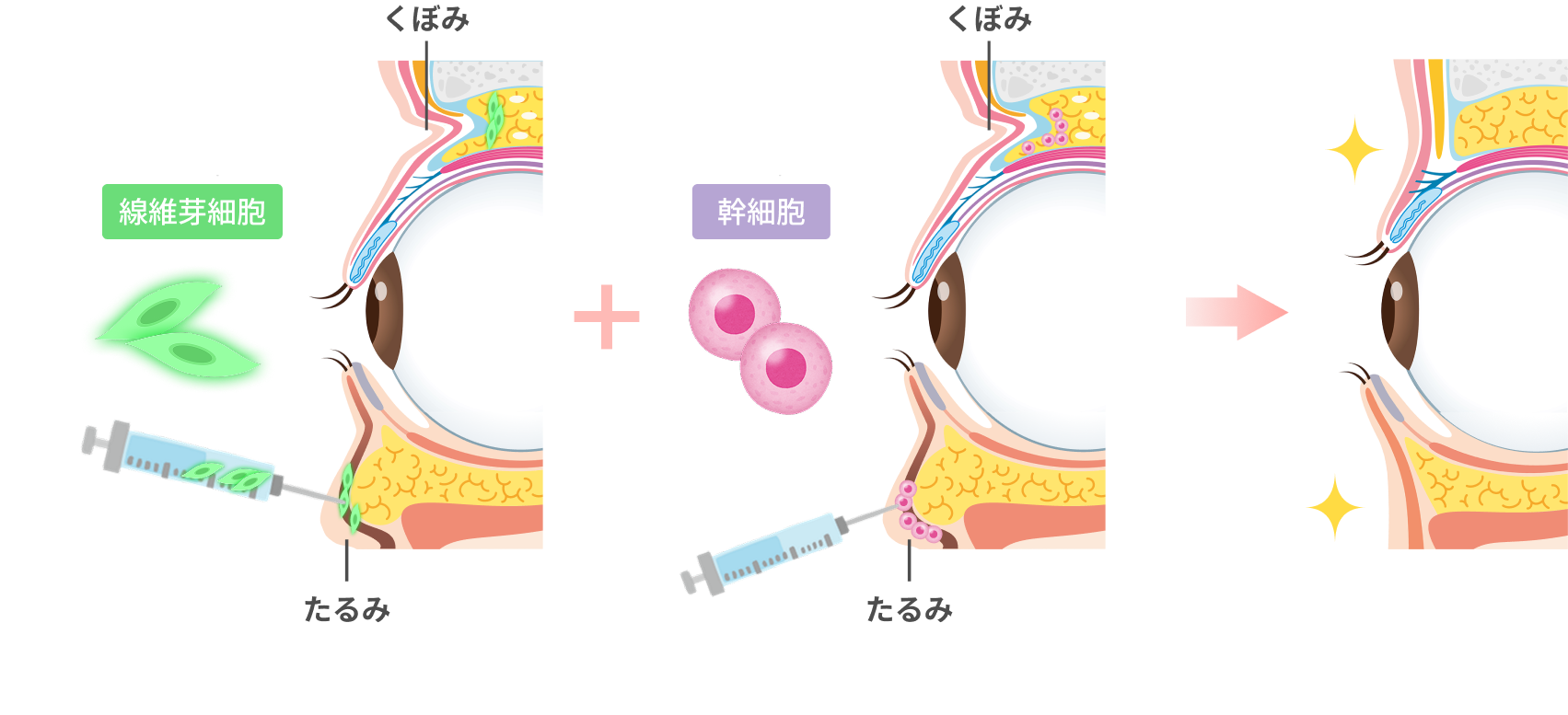 深いほうれい線の図