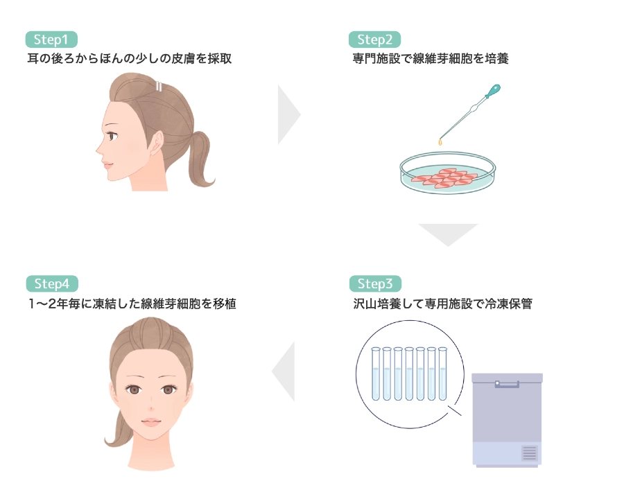 Step1 耳の後ろからほんの少しの皮膚を採取,Step2 専門施設で線維芽細胞を培養,Step3 沢山培養して専用施設で冷凍保管,Step4 1〜2年毎に凍結した線維芽細胞を移植