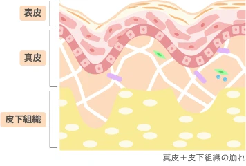 真皮＋皮下組織の崩れた様子を表現したイラスト