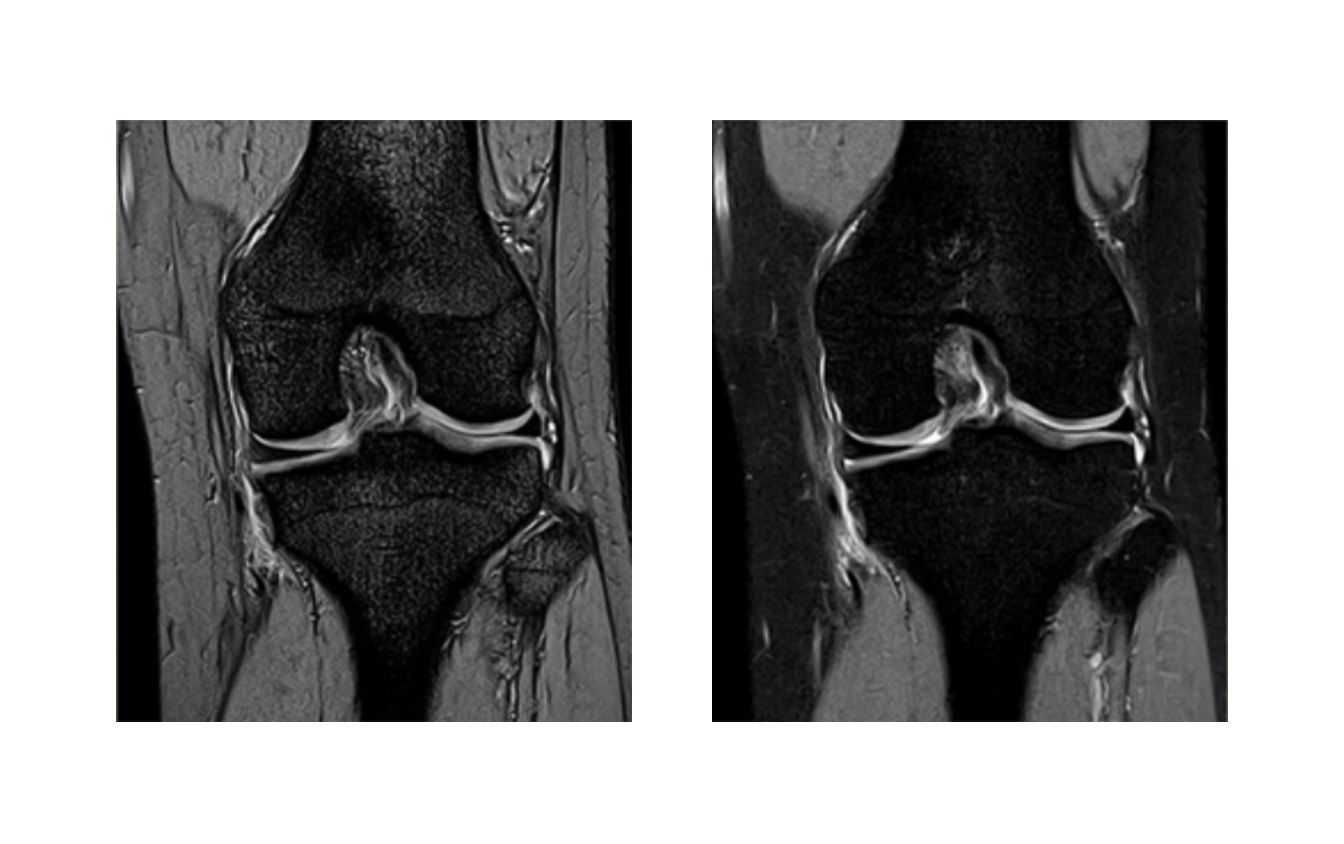 培養幹細胞が膝軟骨に与えた影響